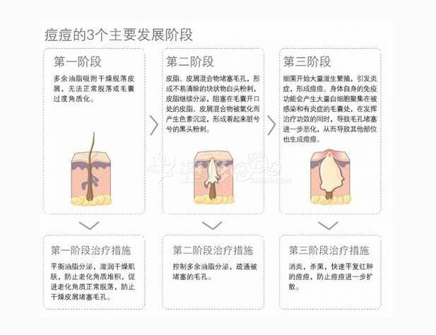 首先是痘痘的形成