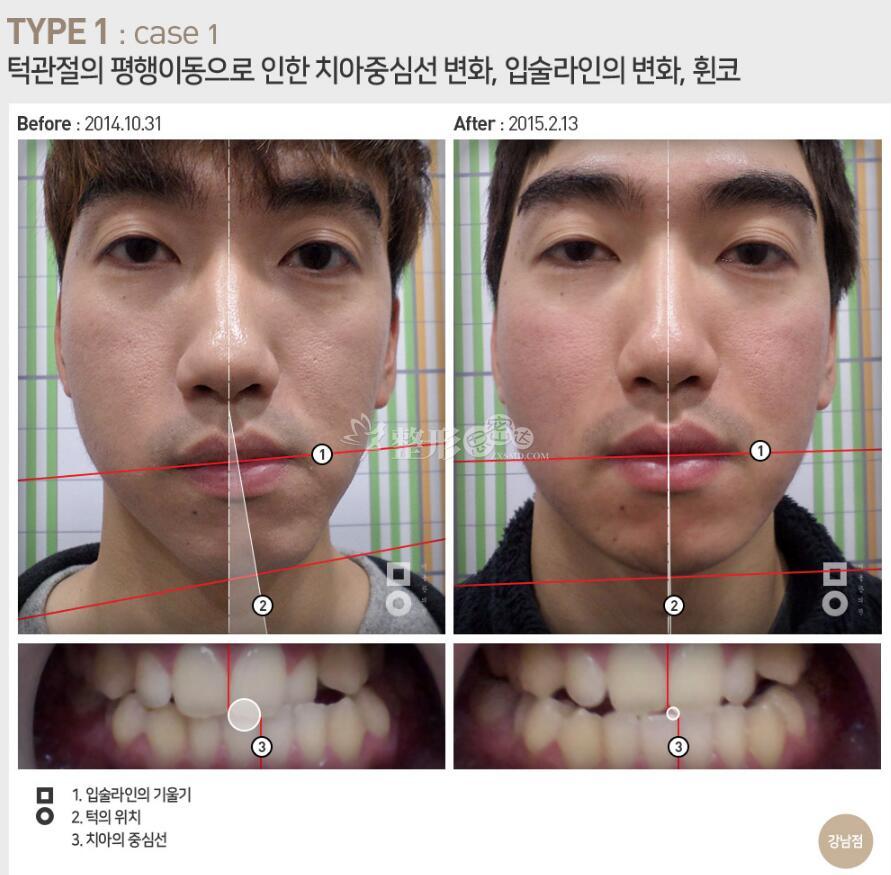 脸部不对称,做双鄂手术? 美尔韩医院的矫正方式来可以解决!